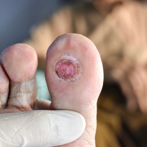 Piede Diabetico